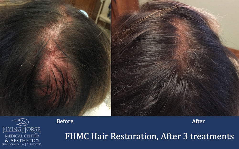 Hair Restoration Treatment Services at Flying Horse Medical Center