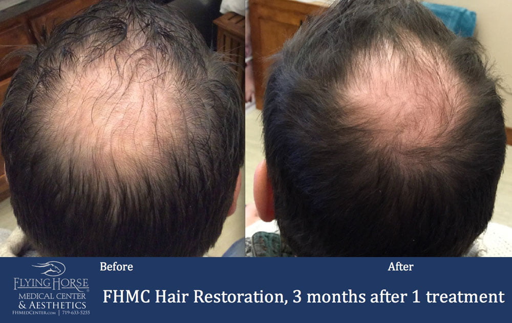 Hair Restoration Treatment Services at Flying Horse Medical Center