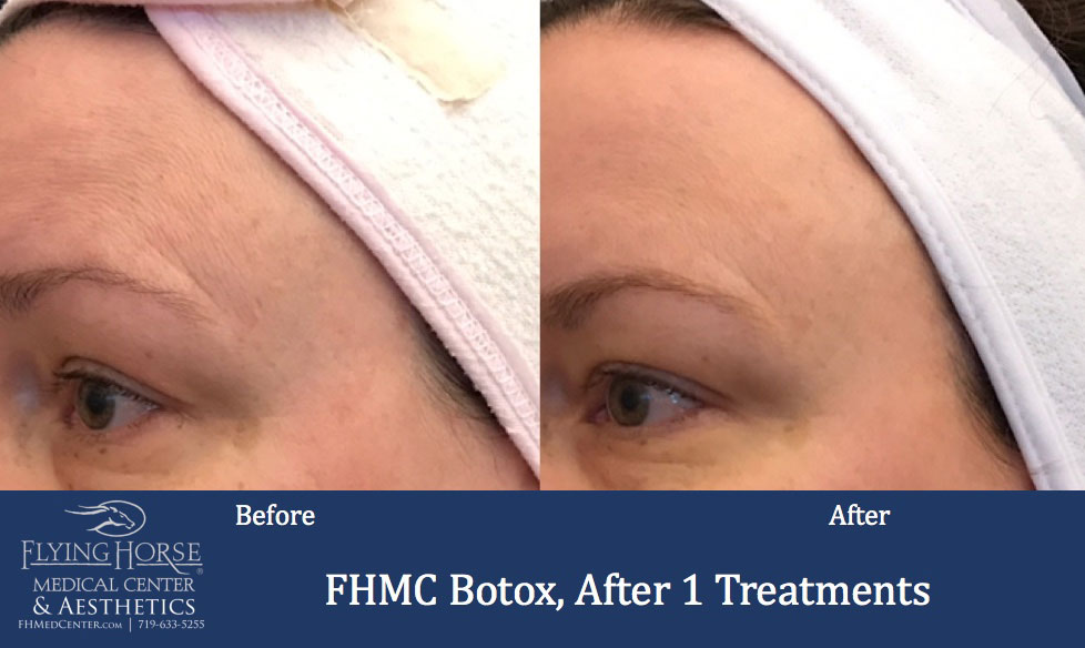 FHMC Botox, After 1 Treatment