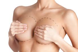 Breast Lift with Breast Implant-Plastic Surgery Flying Horse Medical Center