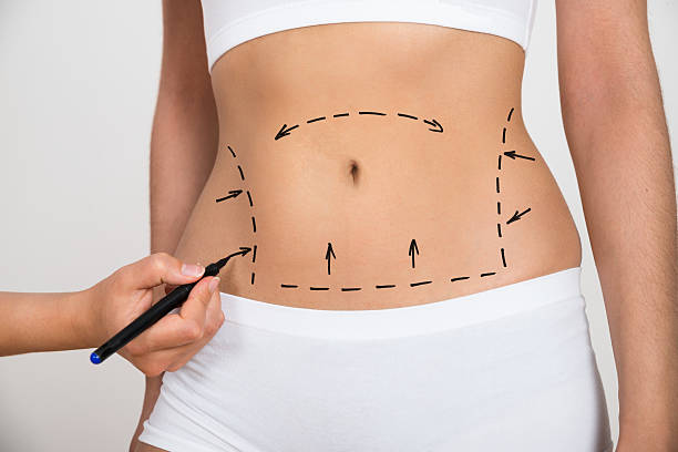 FUPA Liposuction in Colorado Springs