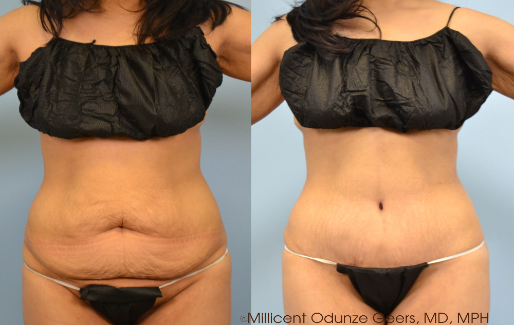 Tummy Tuck Case 4 Before and After - Plastic Surgery Flying Horse Medical Center