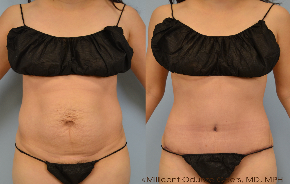 Tummy Tuck Case 5 Before and After - Plastic Surgery Flying Horse Medical Center