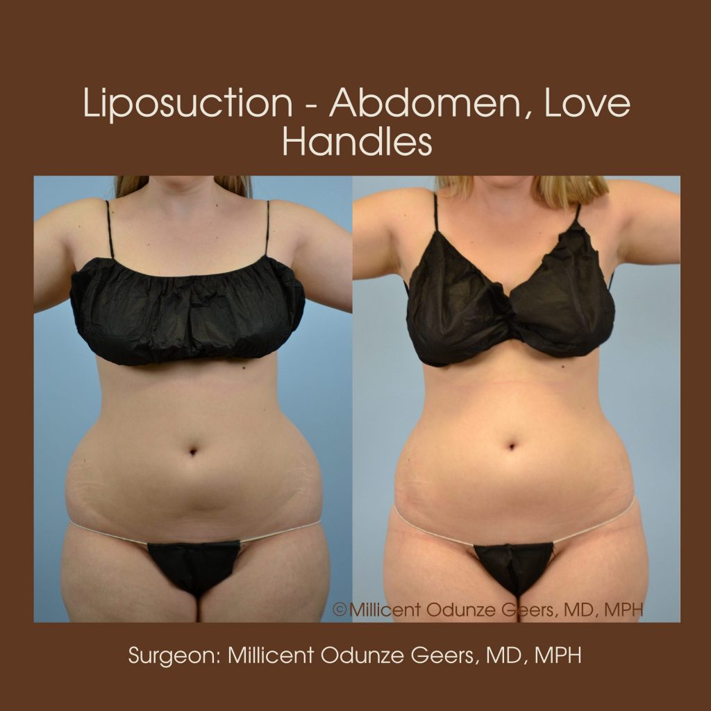 Liposuction - Abdomen / Flanks Before and After Photo Gallery, Coeur  d'Alene, ID