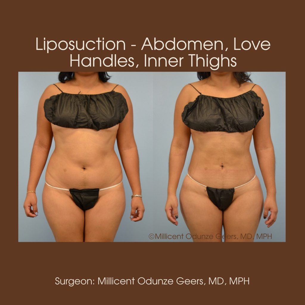 Abdomen, Love Handles, Flanks, Waist Liposuction - Flying Horse Medical Center - Dr. Millicent Odunze Geers