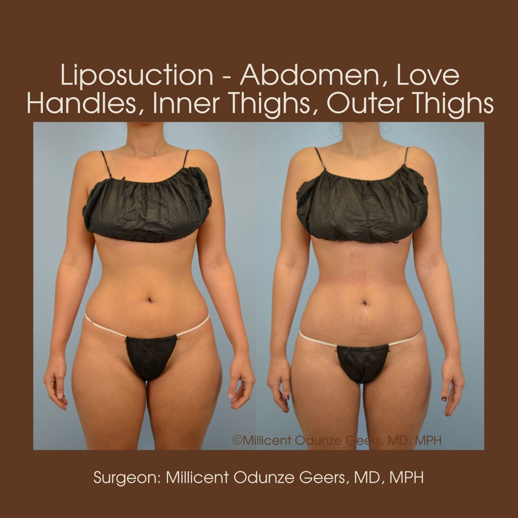 Abdomen, Love Handles, Flanks, Waist Liposuction - Flying Horse Medical Center - Dr. Millicent Odunze Geers