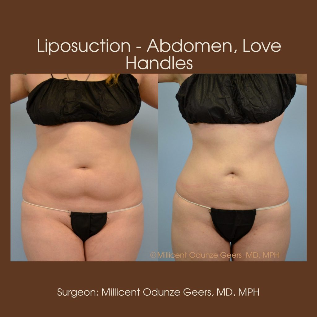 Liposuction - Abdomen / Flanks Before and After Pictures Case 14, Coeur  d'Alene, ID