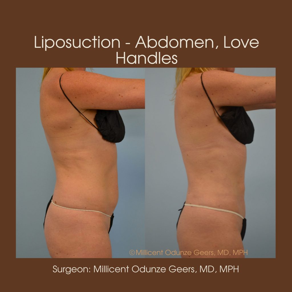 Abdomen, Love Handles, Flanks, Waist Liposuction - Flying Horse Medical Center - Dr. Millicent Odunze Geers
