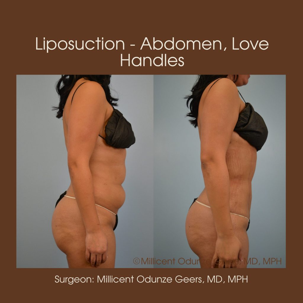 Abdomen, Love Handles, Flanks, Waist Liposuction - Flying Horse Medical Center - Dr. Millicent Odunze Geers