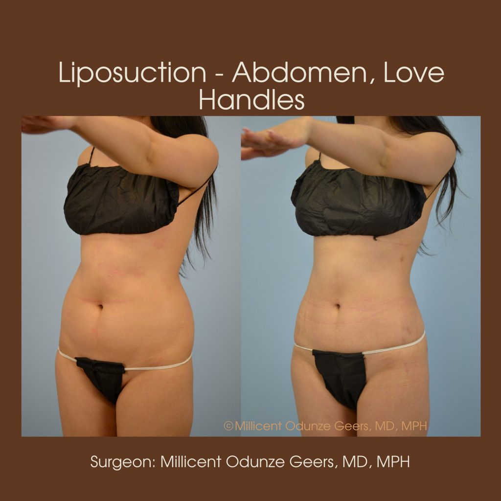Best Colorado Springs Liposuction of Abdomen, Love Handles, Flanks