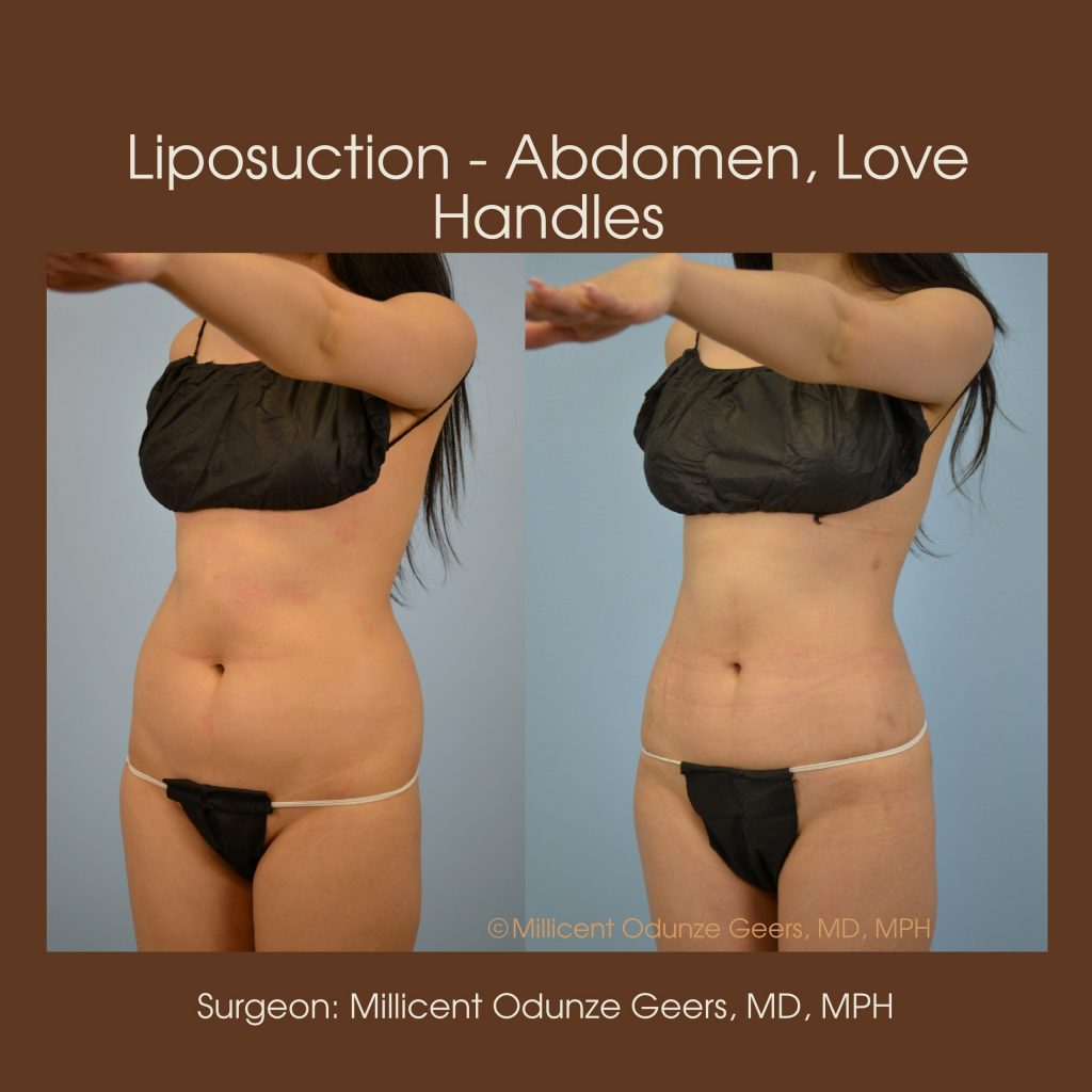Abdomen, Love Handles, Flanks, Waist Liposuction - Flying Horse Medical Center - Dr. Millicent Odunze Geers