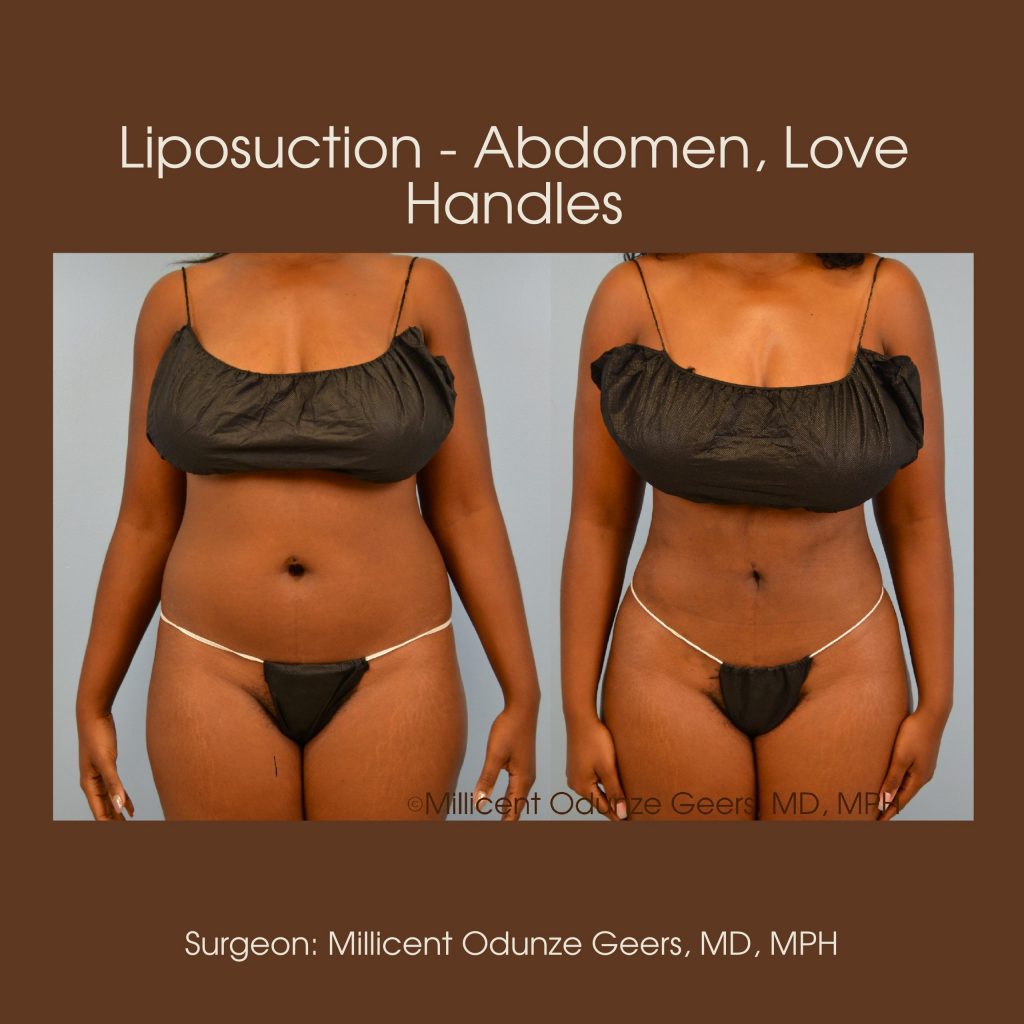 Abdomen, Love Handles, Flanks, Waist Liposuction - Flying Horse Medical Center - Dr. Millicent Odunze Geers
