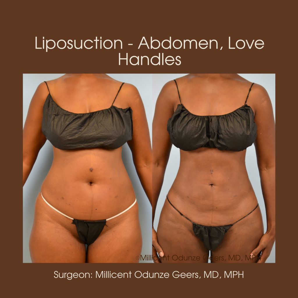 Flank Liposuction Before and After - Glow Aesthetic Medicine