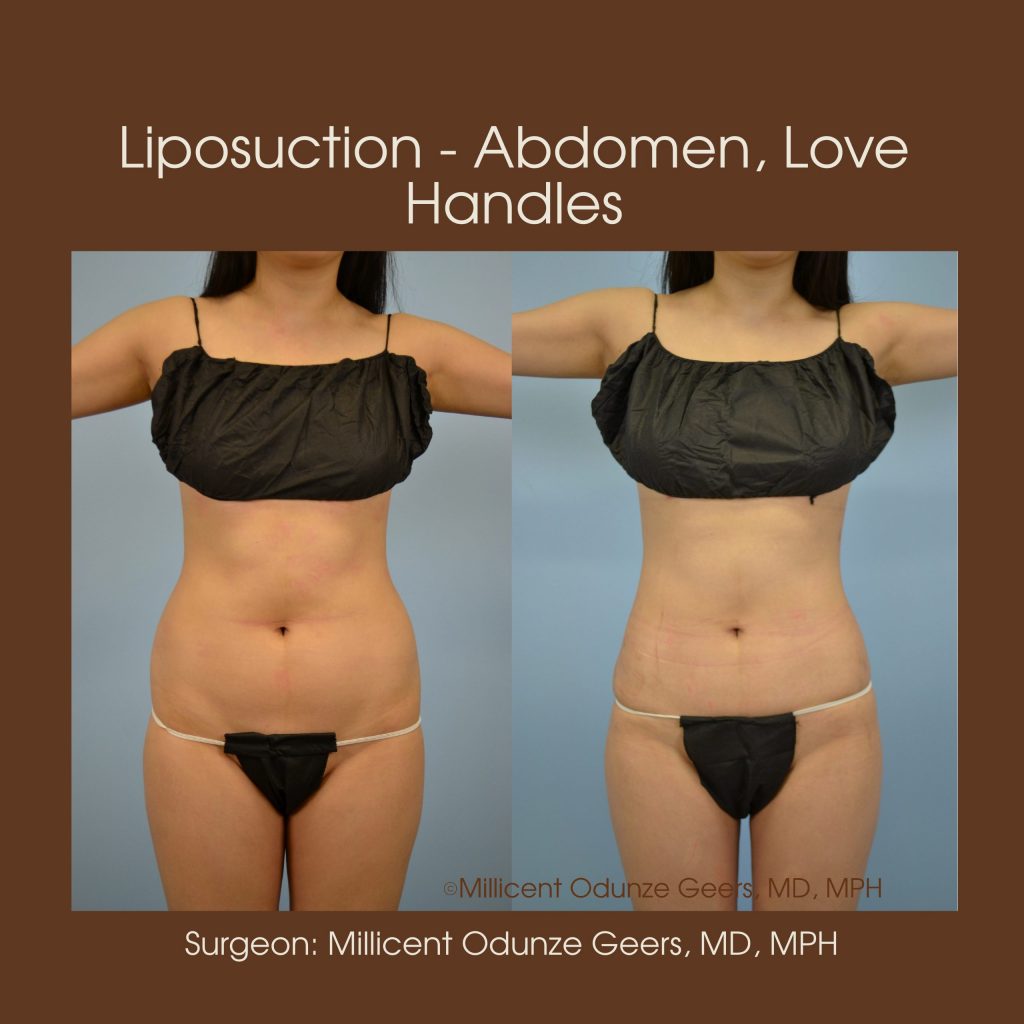 Abdomen, Love Handles, Flanks, Waist Liposuction - Flying Horse Medical Center - Dr. Millicent Odunze Geers