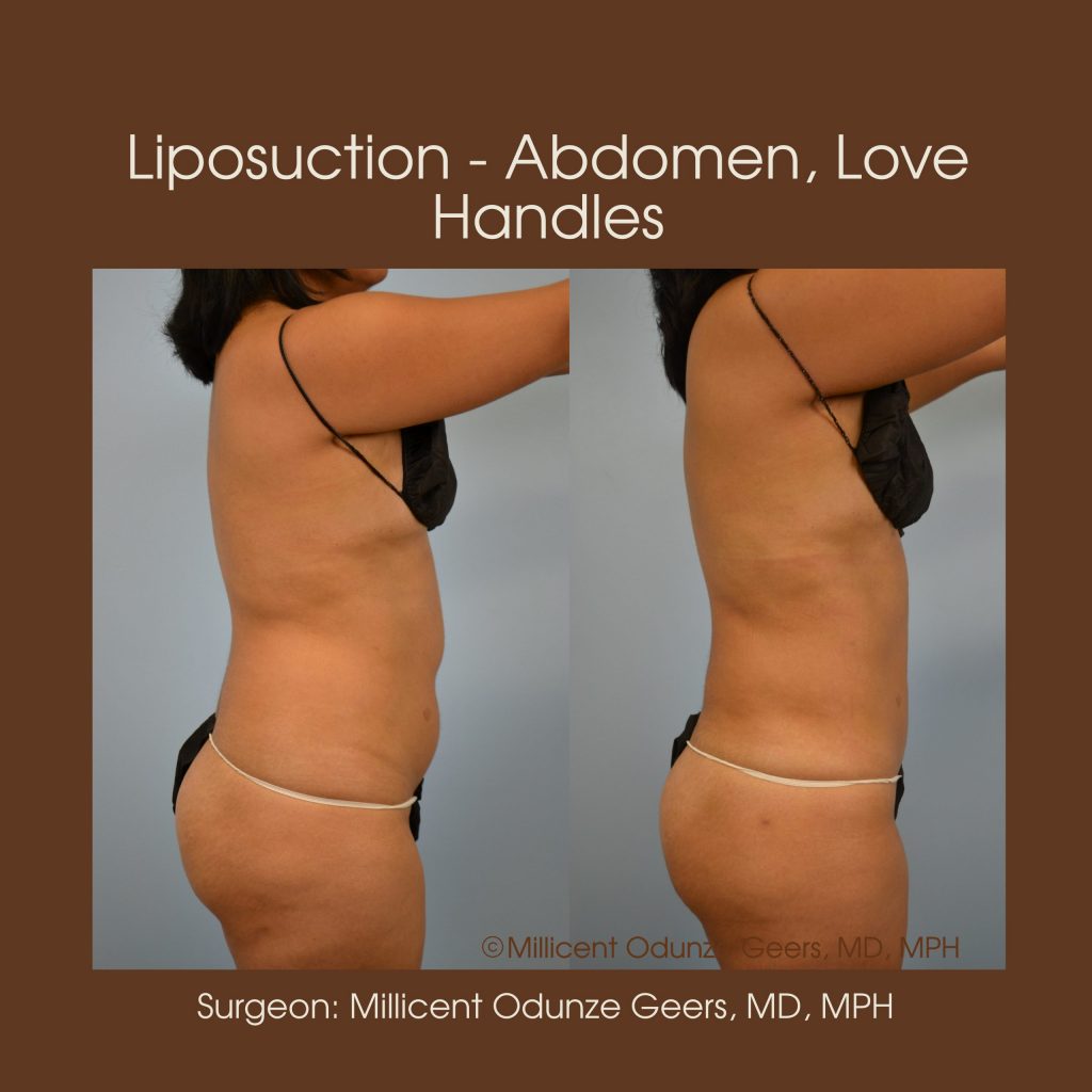 Abdomen, Love Handles, Flanks, Waist Liposuction - Flying Horse Medical Center - Dr. Millicent Odunze Geers