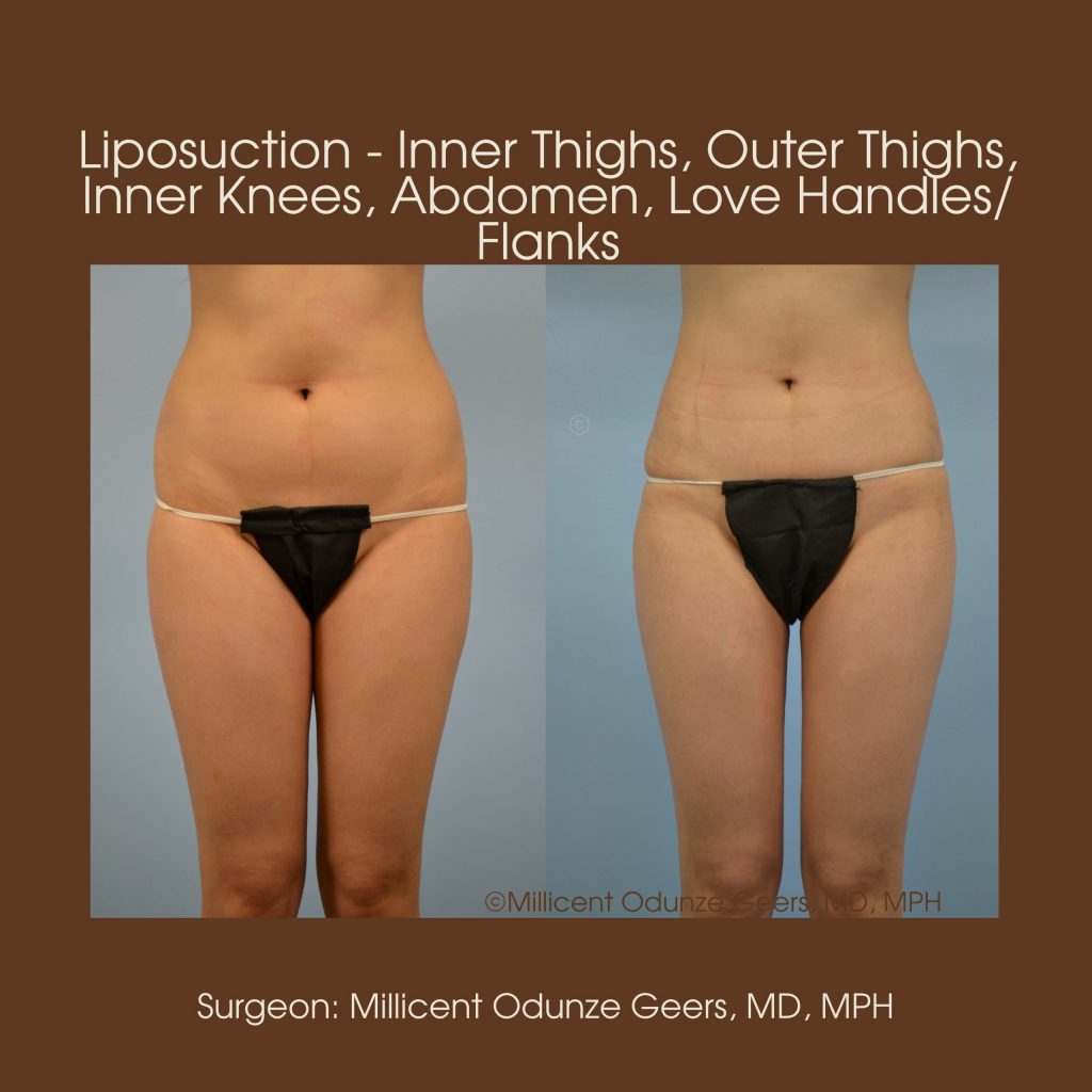 Abdomen, Inner Thighs, Outer Thighs, Inner Knees Liposuction - Flying Horse Medical Center - Dr. Millicent Odunze Geers