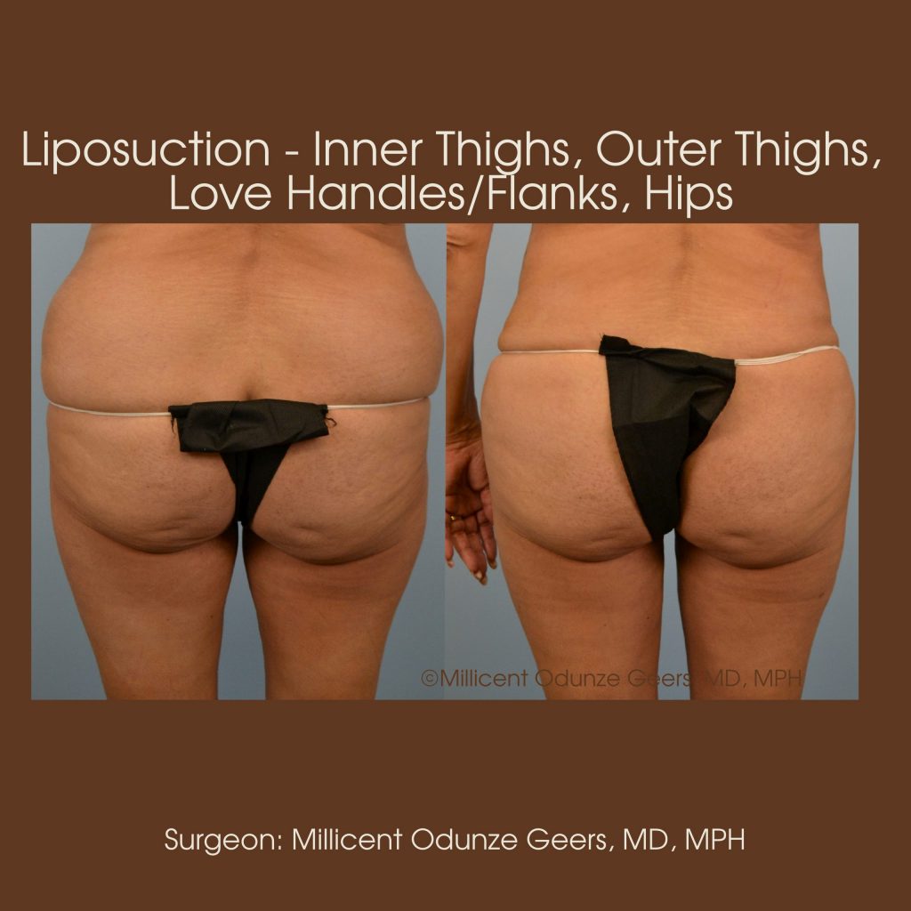 Inner Thighs, Outer Thighs, Inner Knees Liposuction - Flying Horse Medical Center - Dr. Millicent Odunze Geers