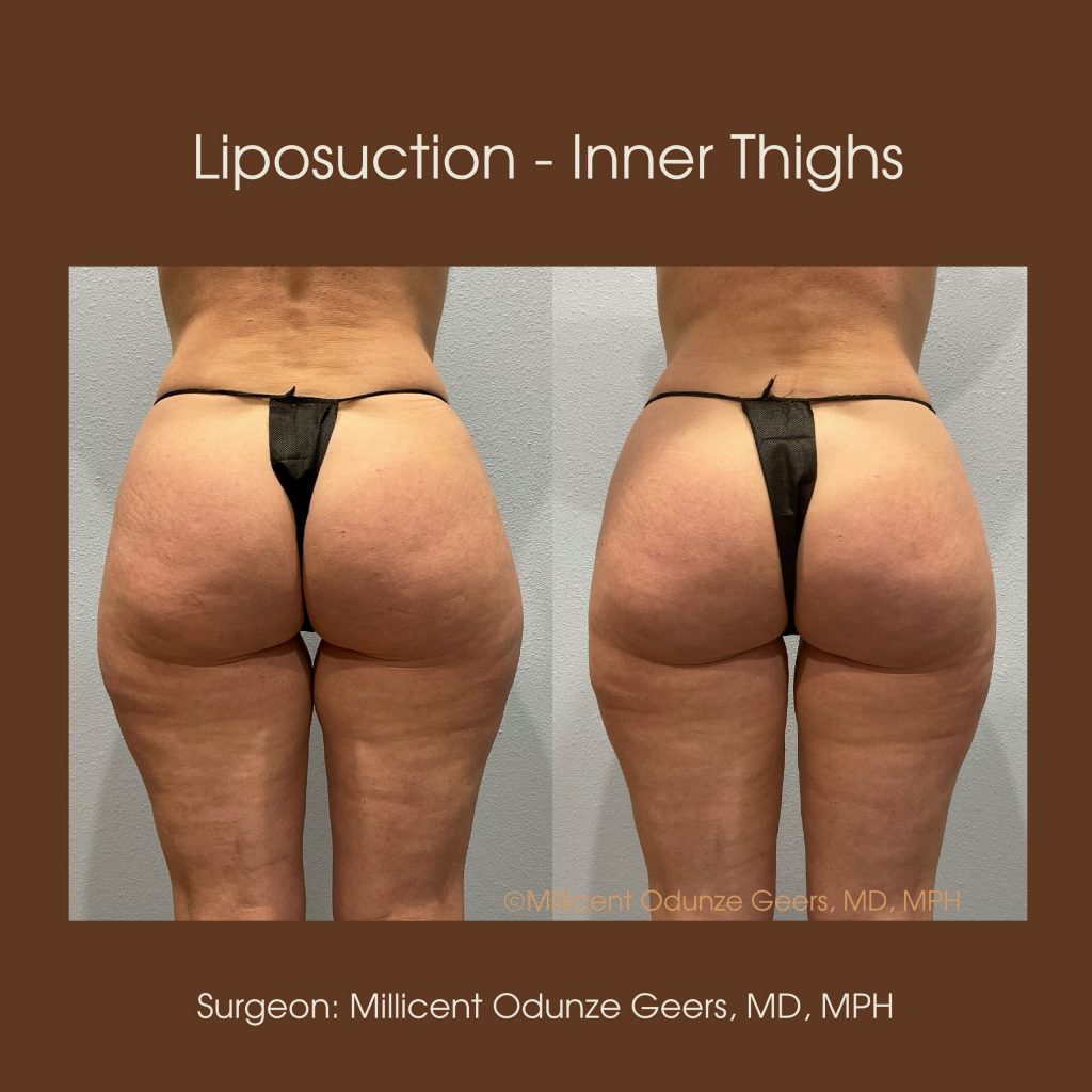 Inner Thighs Liposuction - Flying Horse Medical Center - Dr. Millicent Odunze Geers