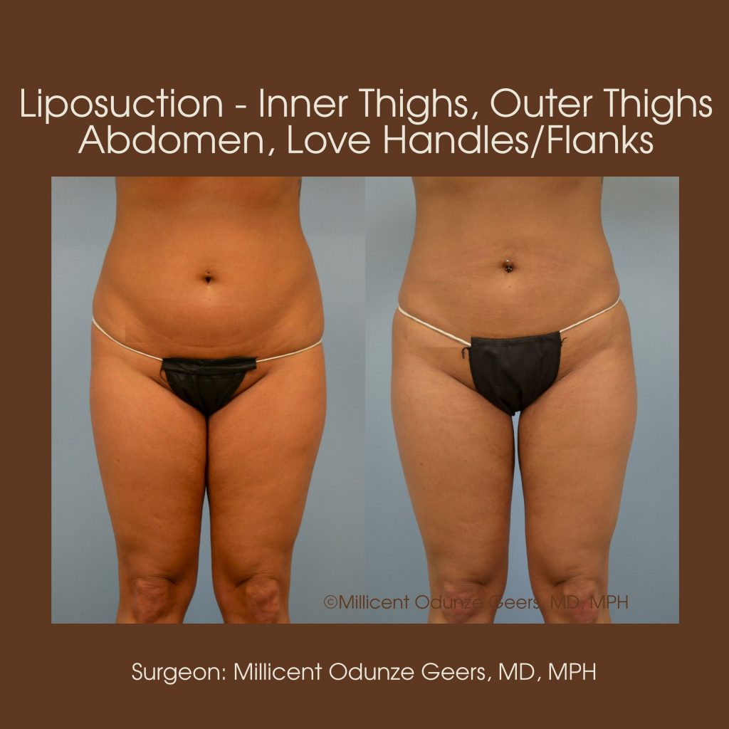 Best Colorado Springs Liposuction of Thighs