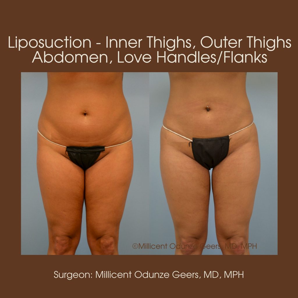 Inner Thighs Liposuction - Flying Horse Medical Center - Dr. Millicent Odunze Geers