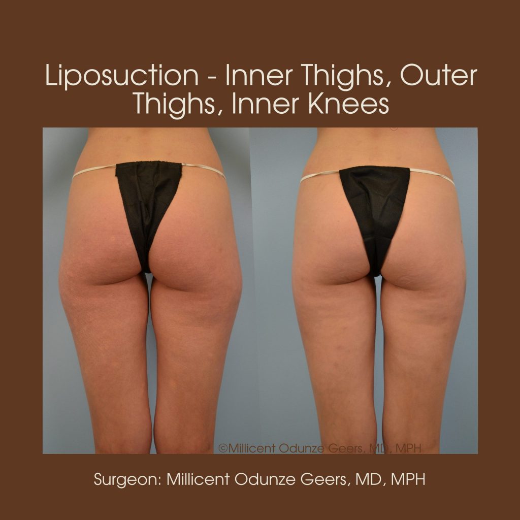 Best Colorado Springs Liposuction of Thighs