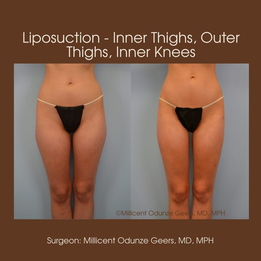 Inner Thighs Liposuction - Flying Horse Medical Center - Dr. Millicent Odunze Geers