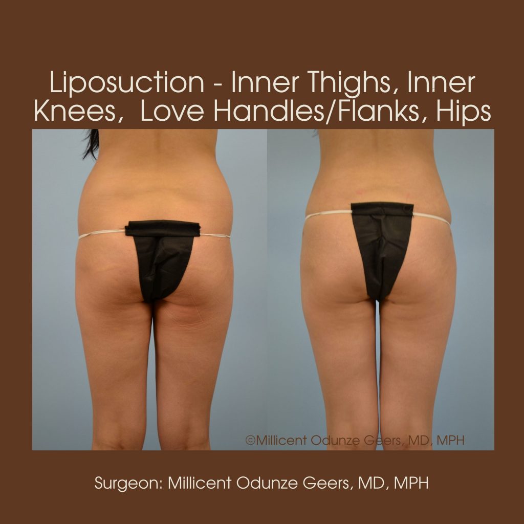 Love Handles, Inner Thighs, Outer Thighs, Inner Knees Liposuction - Flying Horse Medical Center - Dr. Millicent Odunze Geers