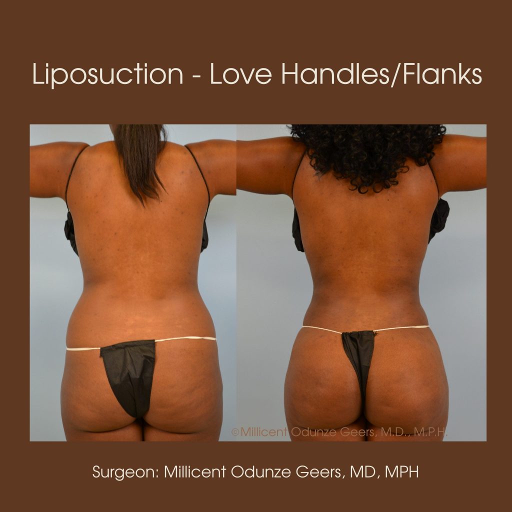 Love Handles, Flanks, Back, Bra Roll Liposuction - Flying Horse Medical Center - Dr. Millicent Odunze Geers