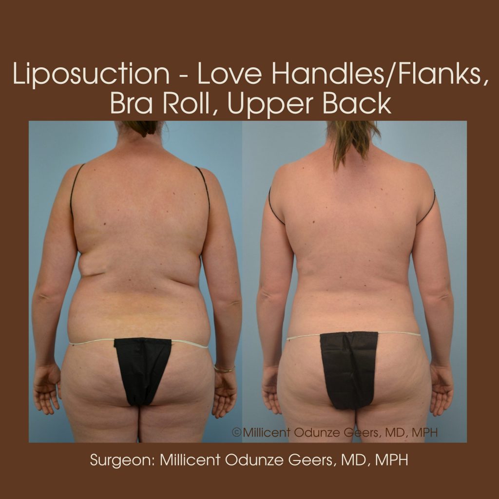 Love Handles, Flanks, Back, Bra Roll Liposuction - Flying Horse Medical Center - Dr. Millicent Odunze Geers