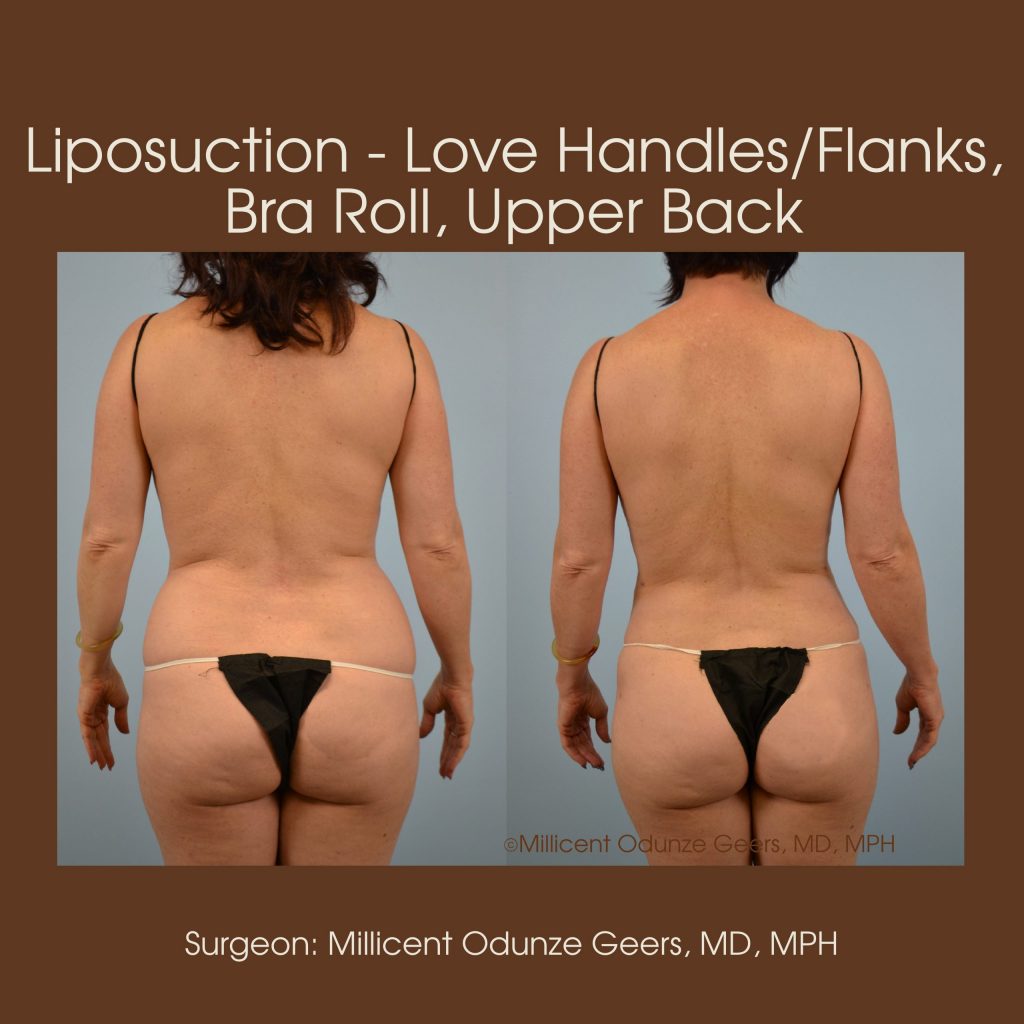 Love Handles, Flanks, Back, Bra Roll Liposuction - Flying Horse Medical Center - Dr. Millicent Odunze Geers