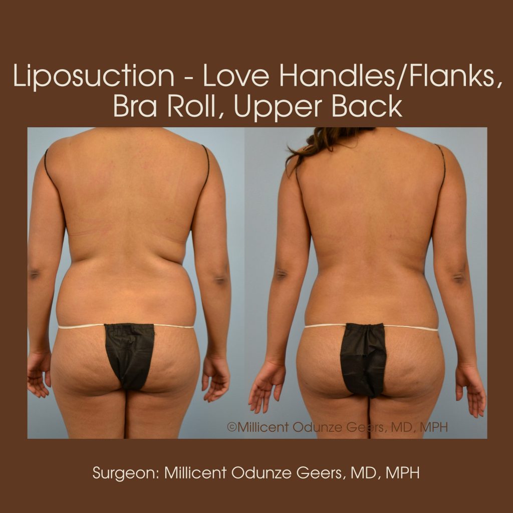 Love Handles, Flanks, Back, Bra Roll Liposuction - Flying Horse Medical Center - Dr. Millicent Odunze Geers