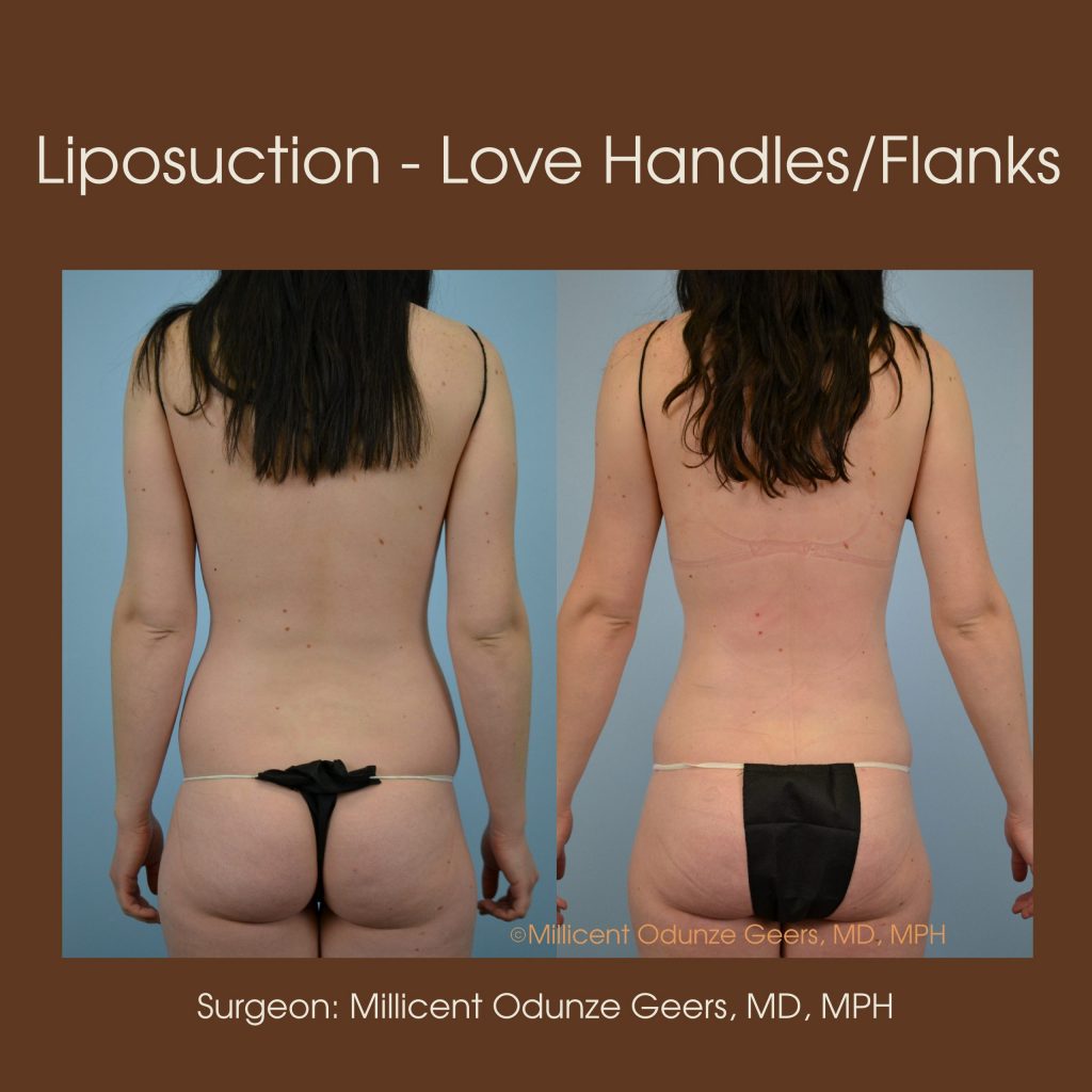 Love Handles, Flanks, Back, Bra Roll Liposuction - Flying Horse Medical Center - Dr. Millicent Odunze Geers