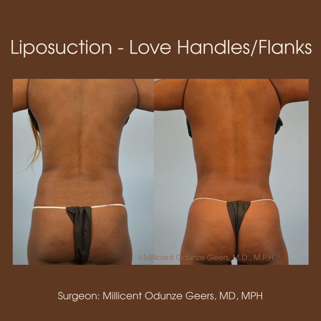 Love Handles, Flanks, Back, Bra Roll Liposuction - Flying Horse Medical Center - Dr. Millicent Odunze Geers