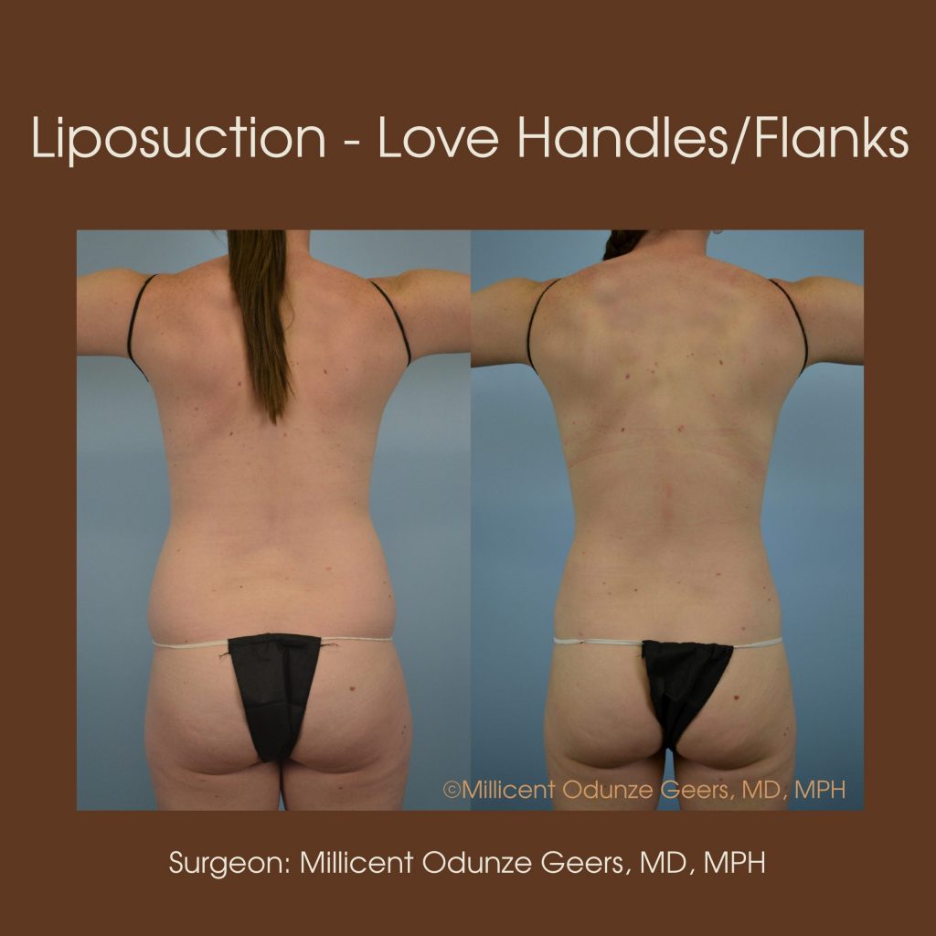 Love Handles, Flanks, Back, Bra Roll Liposuction - Flying Horse Medical Center - Dr. Millicent Odunze Geers