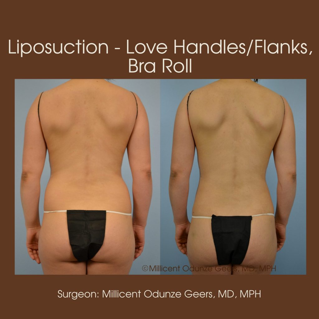 Liposuction of the 'love handles' or flanks