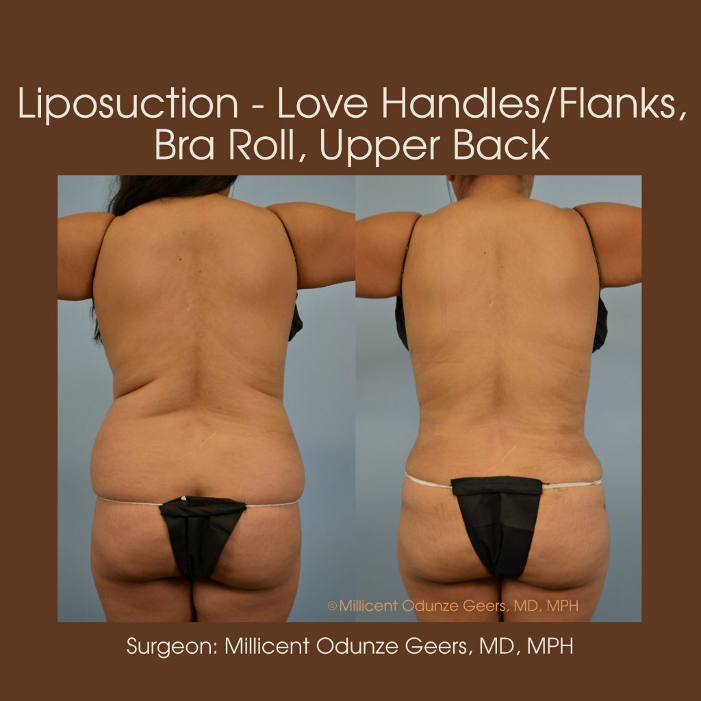 Love Handles, Flanks, Back, Bra Roll Liposuction - Flying Horse Medical Center - Dr. Millicent Odunze Geers