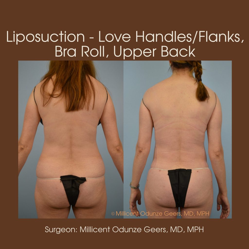 Love Handles, Flanks, Back, Bra Roll Liposuction - Flying Horse Medical Center - Dr. Millicent Odunze Geers