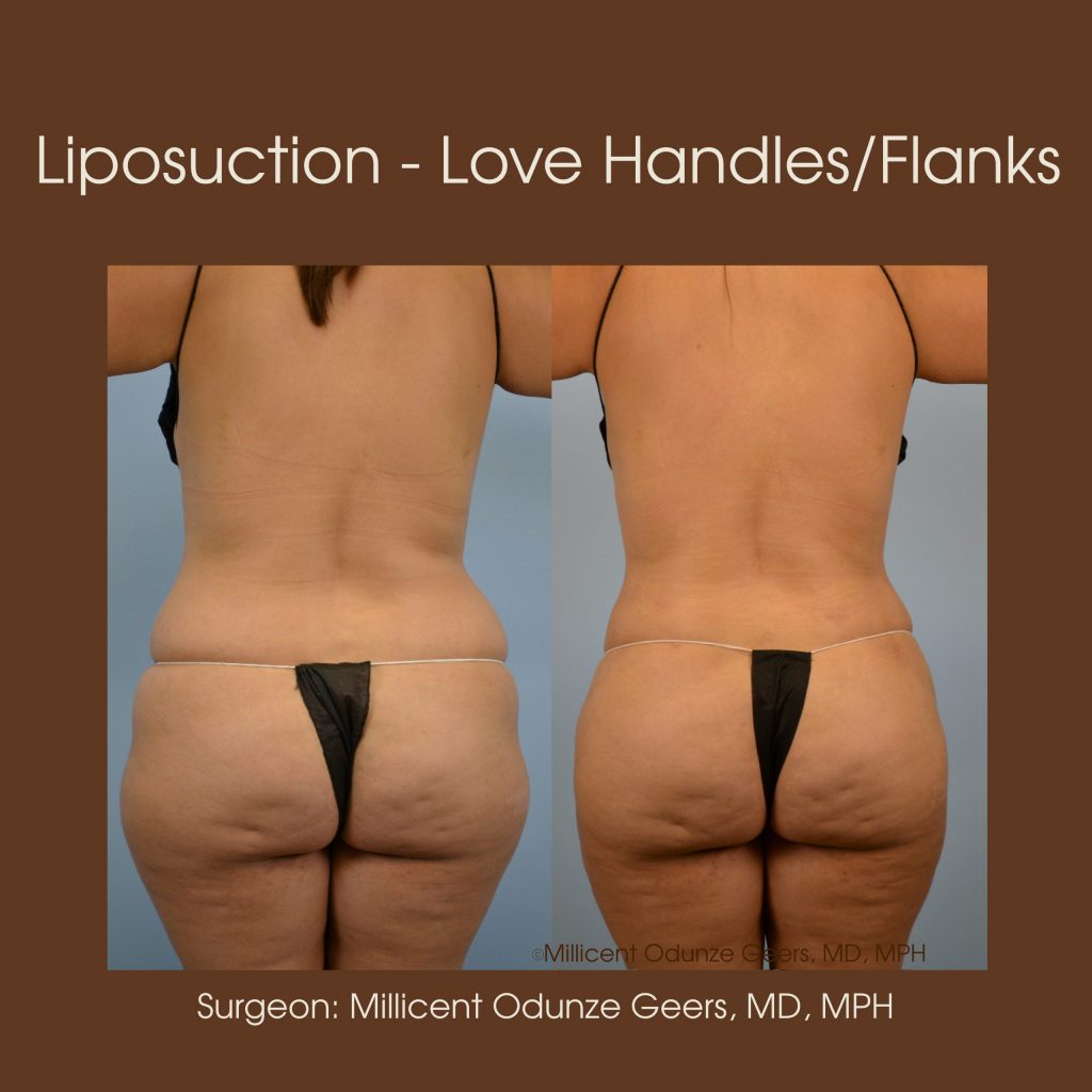 Love Handles, Flanks, Back, Bra Roll Liposuction - Flying Horse Medical Center - Dr. Millicent Odunze Geers