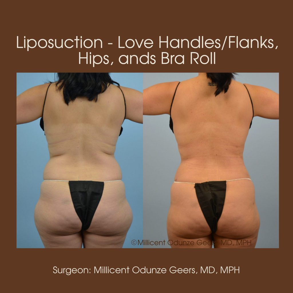 Love Handles, Flanks, Back, Bra Roll Liposuction - Flying Horse Medical Center - Dr. Millicent Odunze Geers