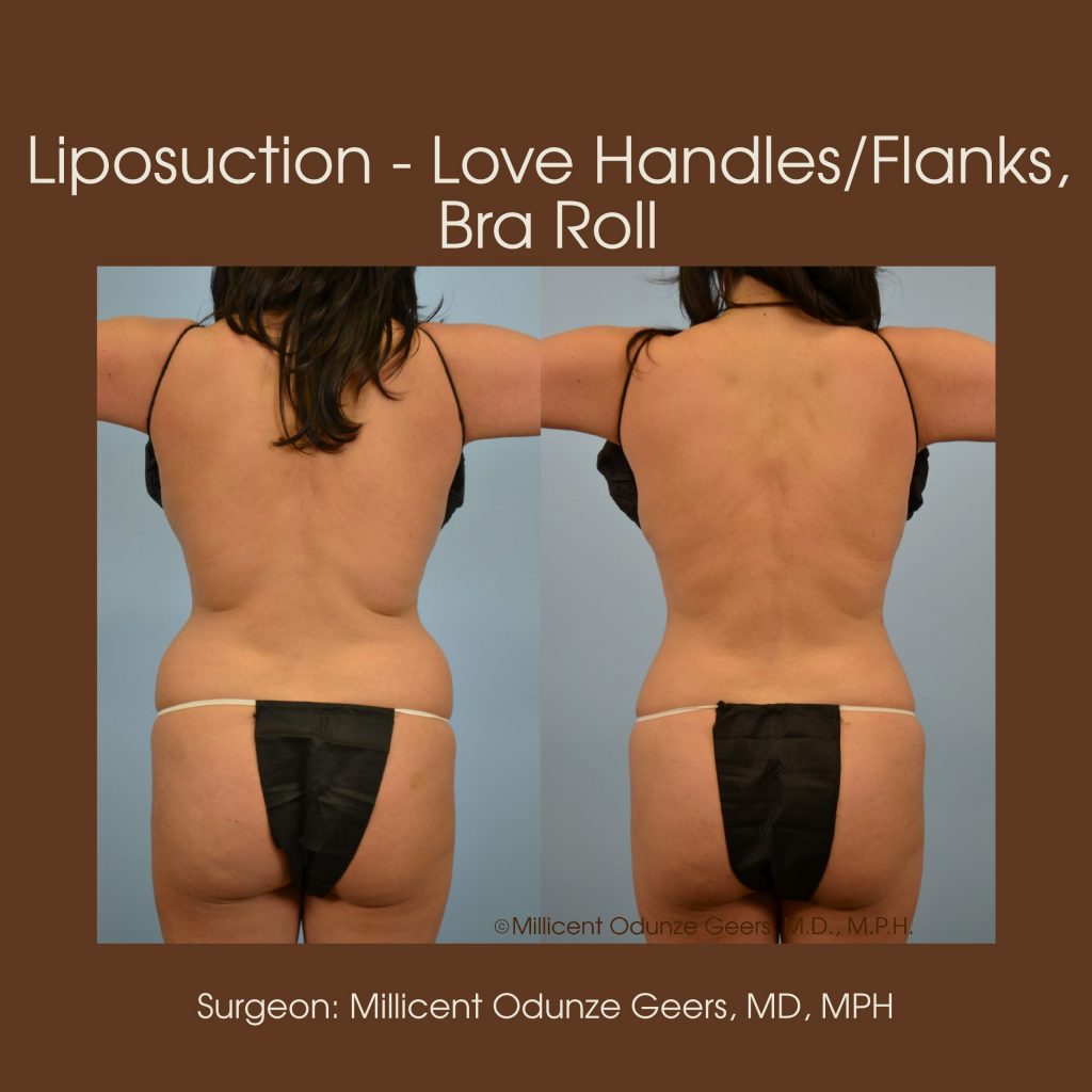 Love Handles, Flanks, Back, Bra Roll Liposuction - Flying Horse Medical Center - Dr. Millicent Odunze Geers