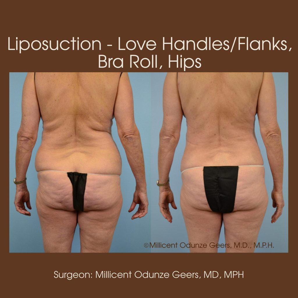 Love Handles, Flanks, Back, Bra Roll Liposuction - Flying Horse Medical Center - Dr. Millicent Odunze Geers