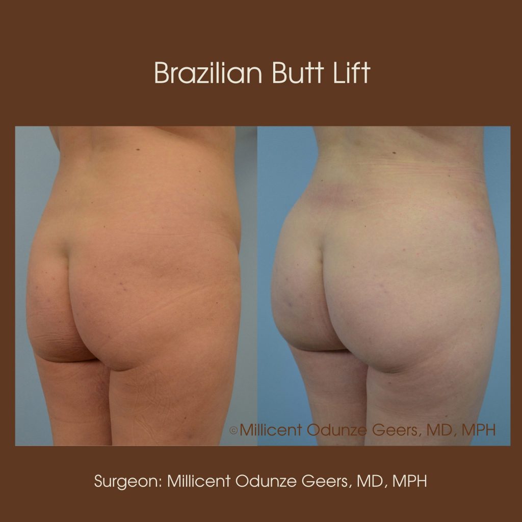Brazilian Butt Lift -Flying Horse Medical Center - Dr. Millicent Odunze Geers