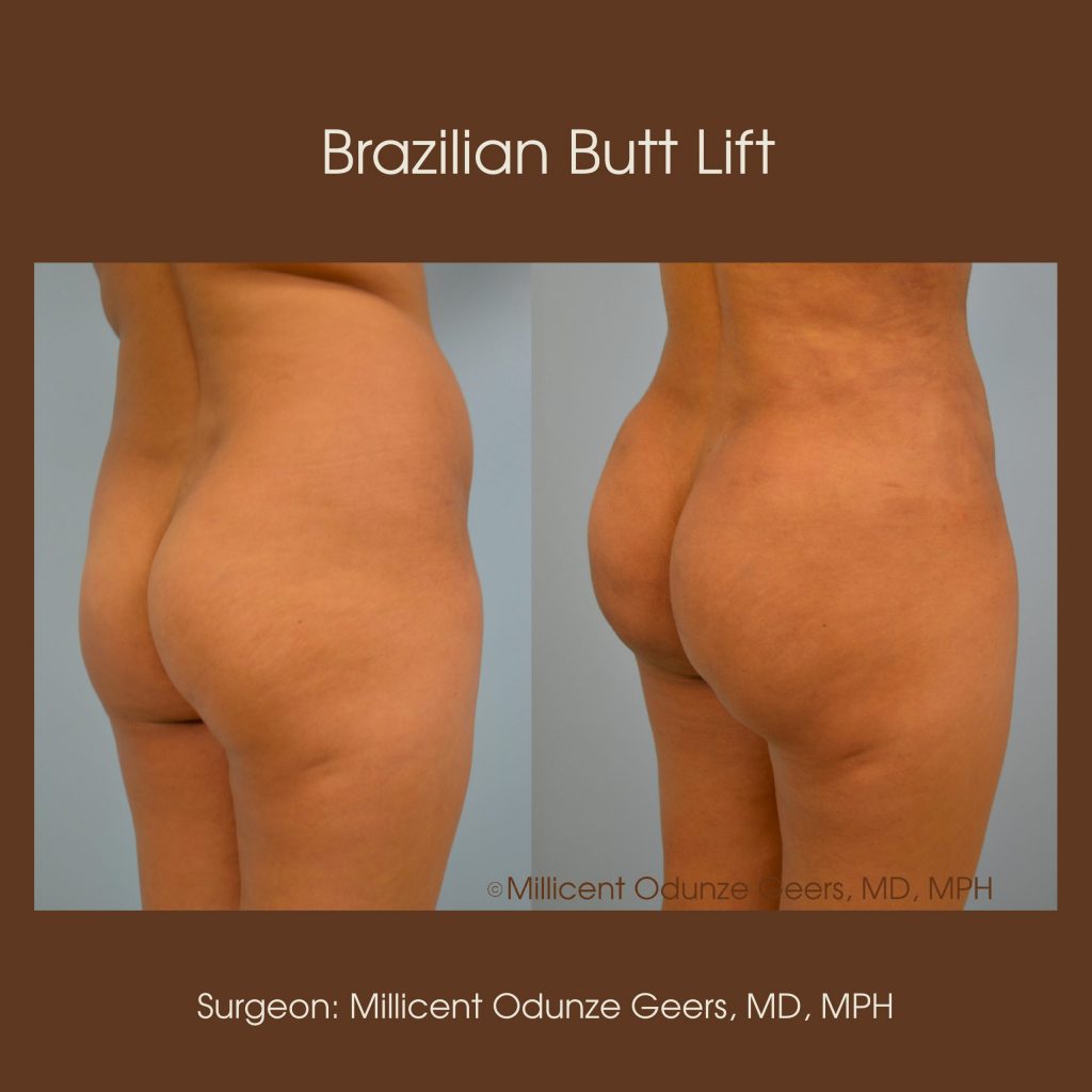 Brazilian Butt Lift -Flying Horse Medical Center - Dr. Millicent Odunze Geers