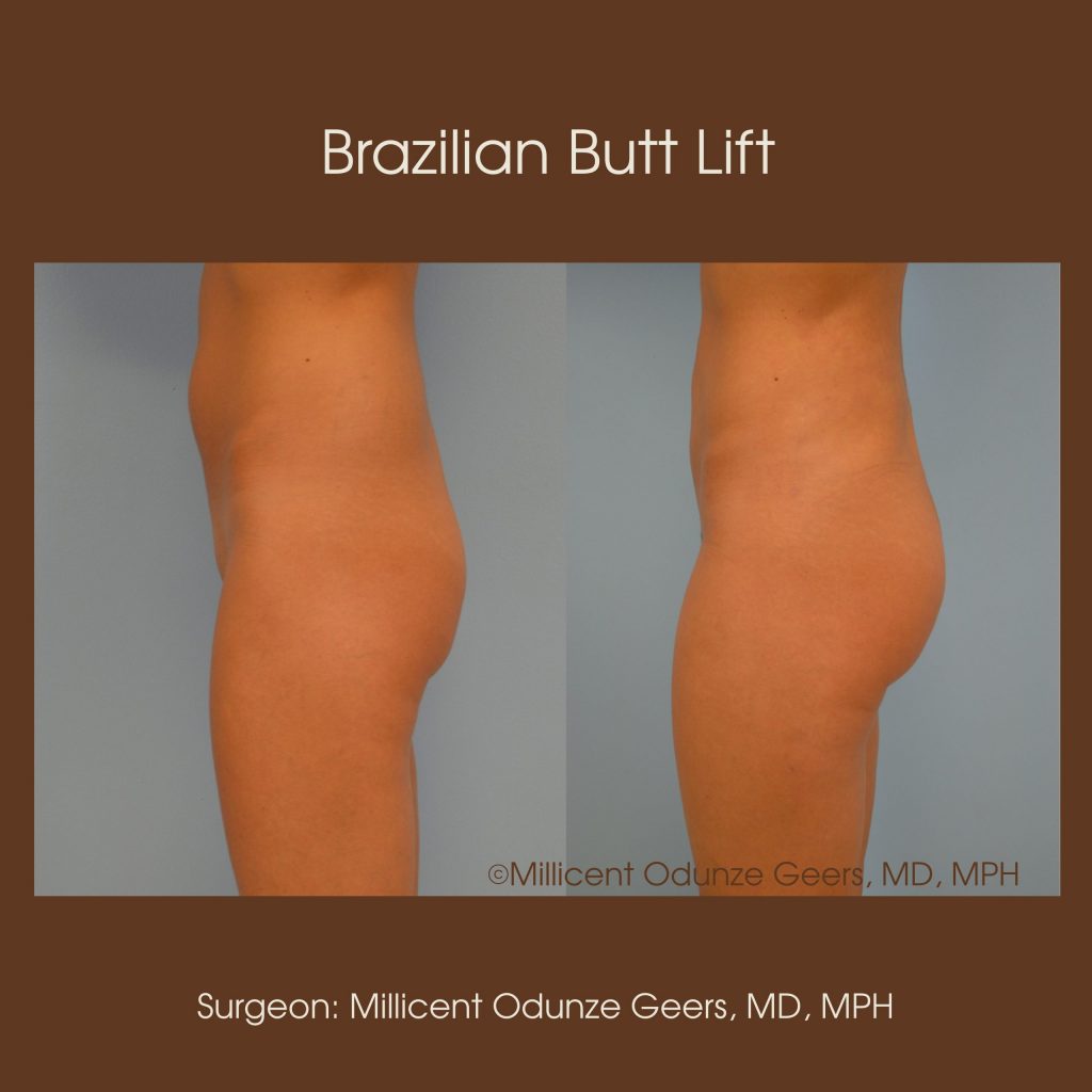 Brazilian Butt Lift -Flying Horse Medical Center - Dr. Millicent Odunze Geers