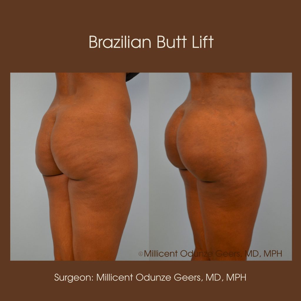 Brazilian Butt Lift -Flying Horse Medical Center - Dr. Millicent Odunze Geers