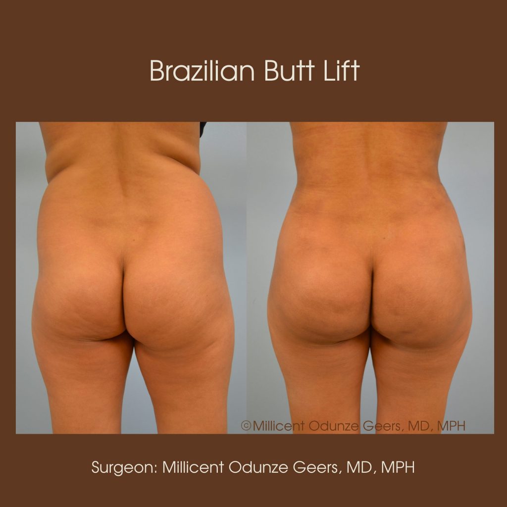 Brazilian Butt Lift -Flying Horse Medical Center - Dr. Millicent Odunze Geers
