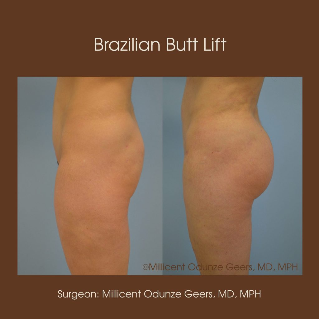 Brazilian Butt Lift -Flying Horse Medical Center - Dr. Millicent Odunze Geers