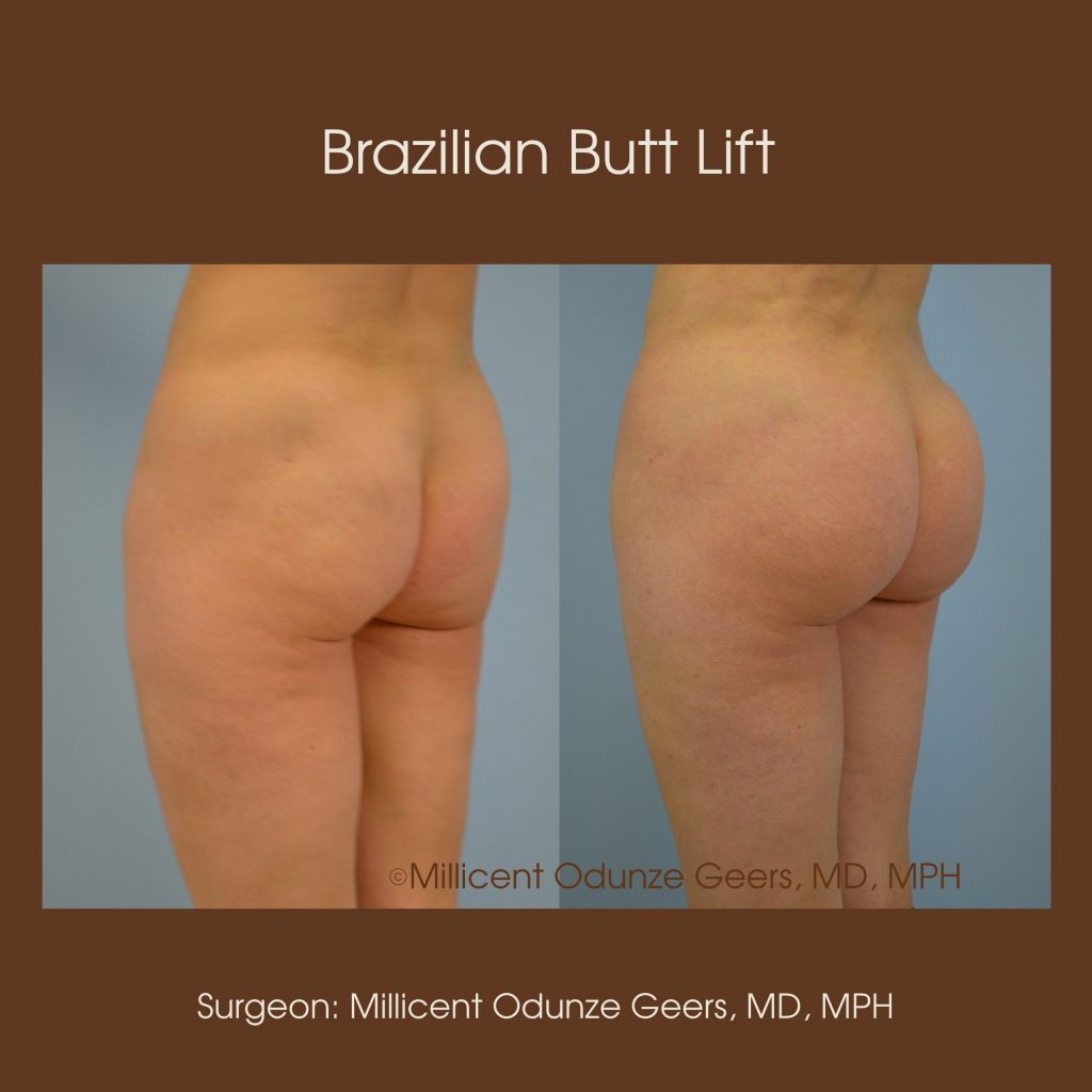 Brazilian Butt Lift -Flying Horse Medical Center - Dr. Millicent Odunze Geers