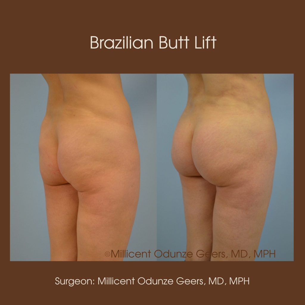 Brazilian Butt Lift -Flying Horse Medical Center - Dr. Millicent Odunze Geers