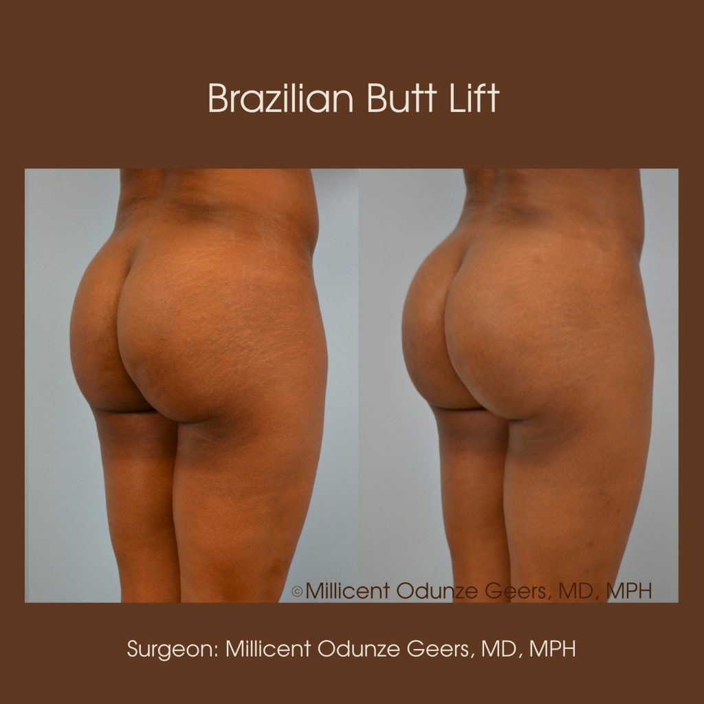 Brazilian Butt Lift -Flying Horse Medical Center - Dr. Millicent Odunze Geers